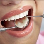 Czy warto zdecydować się na implanty zębowe?